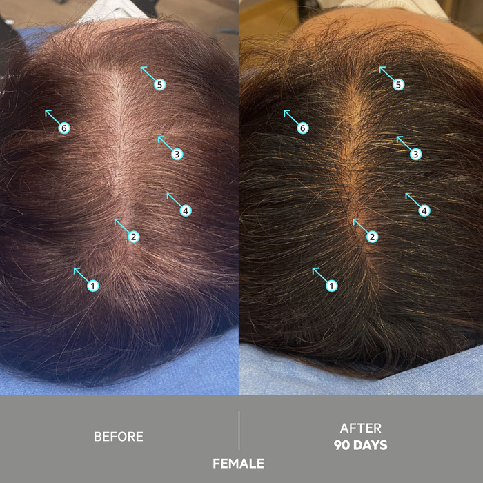 SPECTRAL EXTRA STRENGTH® 3 Month Supply | 7% Nanoxidil
